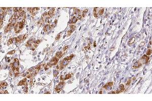 ABIN6278051 at 1/100 staining Human liver cancer tissue by IHC-P. (Angiotensin II Type 2 Receptor Antikörper)