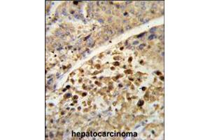 Formalin-fixed and paraffin-embedded human hepatocarcinoma reacted with NR1I2 Antibody , which was peroxidase-conjugated to the secondary antibody, followed by DAB staining. (NR1I2 Antikörper  (AA 100-127))