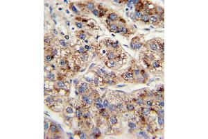 Formalin-fixed and paraffin-embedded human hepatocarcinoma with EHHADH Antibody , which was peroxidase-conjugated to the secondary antibody, followed by DAB staining. (EHHADH Antikörper  (C-Term))