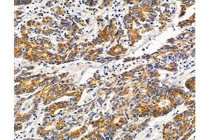 ABIN7095825 and ABIN7099887 at 1/100 staining human colorectal cancer by IHC-P. (RNF170 Antikörper)
