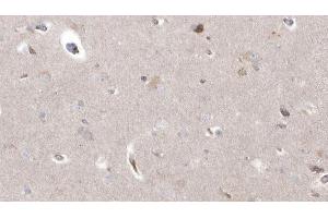 ABIN6273038 at 1/100 staining Human brain cancer tissue by IHC-P. (CYP26B1 Antikörper  (Internal Region))