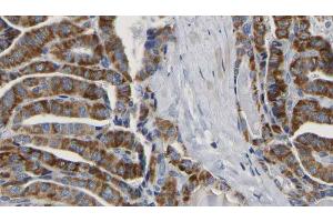 ABIN6267164 at 1/100 staining Human thyroid cancer tissue by IHC-P. (DLG4 Antikörper  (pSer295))