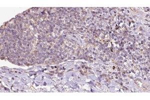 ABIN6273151 at 1/100 staining Human lymph cancer tissue by IHC-P. (Peroxiredoxin 5 Antikörper  (C-Term))