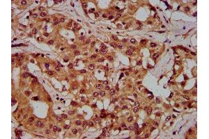 IHC image of ABIN7162774 diluted at 1:300 and staining in paraffin-embedded human liver cancer performed on a Leica BondTM system. (PGLYRP1 Antikörper  (AA 22-196))
