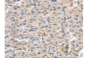 The image on the left is immunohistochemistry of paraffin-embedded Human liver cancer tissue using ABIN7191331(LZTS1 Antibody) at dilution 1/20, on the right is treated with synthetic peptide. (LZTS1 Antikörper)