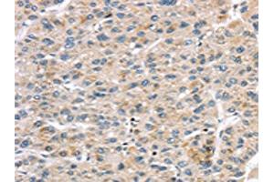 The image on the left is immunohistochemistry of paraffin-embedded Human liver cancer tissue using ABIN7191331(LZTS1 Antibody) at dilution 1/20, on the right is treated with synthetic peptide.