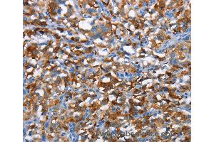 Immunohistochemistry of Human gastric cancer using CD226 Polyclonal Antibody at dilution of 1:60 (CD226 Antikörper)