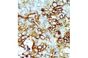 Formalin-fixed and paraffin-embedded human cancer tissue reacted with the primary antibody, which was peroxidase-conjugated to the secondary antibody, followed by AEC staining. (MAP4K2 Antikörper  (Middle Region))