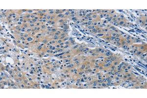 Immunohistochemistry of paraffin-embedded Human gastric cancer tissue using BMPR1B Polyclonal Antibody at dilution 1:30 (BMPR1B Antikörper)