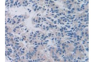Detection of PALB in Human Prostate cancer Tissue using Polyclonal Antibody to Prealbumin (PALB) (TTR Antikörper  (AA 21-147))