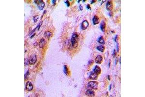 Immunohistochemical analysis of Recoverin staining in human lung cancer formalin fixed paraffin embedded tissue section. (Recoverin Antikörper)