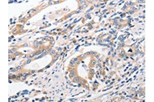 The image on the left is immunohistochemistry of paraffin-embedded Human gastic cancer tissue using ABIN7191756(P2RY11 Antibody) at dilution 1/40, on the right is treated with synthetic peptide. (P2RY11 Antikörper)