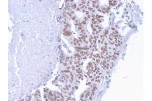 Formalin-fixed, paraffin-embedded human Breast Carcinoma stained with CHD4 Mouse Monoclonal Antibody (3F2/4). (CHD4 Antikörper  (C-Term))