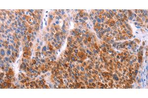 Immunohistochemistry of paraffin-embedded Human liver cancer using AADAC Polyclonal Antibody at dilution of 1:30 (AADAC Antikörper)
