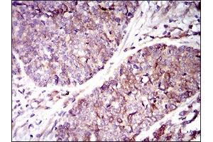 Immunohistochemical analysis of paraffin-embedded esophageal cancer tissues using GUCY1A3 mouse mAb with DAB staining. (GUCY1A1 Antikörper  (AA 22-214))