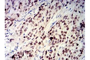Immunohistochemical analysis of paraffin-embedded bladder cancer tissues using CIRBP mouse mAb with DAB staining. (CIRBP Antikörper  (AA 1-90))
