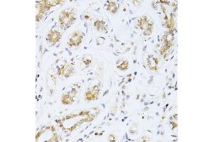 Immunohistochemistry of paraffin-embedded human breast cancer using ETV1 antibody. (ETV1 Antikörper)