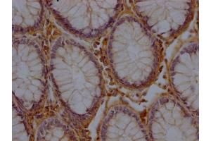 IHC image of ABIN7156171 diluted at 1:200 and staining in paraffin-embedded human colon cancer performed on a Leica BondTM system. (RHBDF2 Antikörper  (AA 1-200))