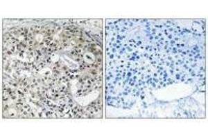 Immunohistochemistry analysis of paraffin-embedded human breast carcinoma tissue using CNTD2 antibody. (CNTD2 Antikörper)