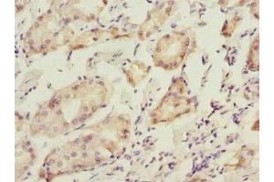 Immunohistochemistry of paraffin-embedded human gastric cancer using ABIN7165283 at dilution of 1:100 (PDIA6 Antikörper  (AA 20-300))