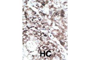 Formalin-fixed and paraffin-embedded human hepatocellular carcinoma tissue reacted with GPR37 polyclonal antibody  , which was peroxidase-conjugated to the secondary antibody, followed by DAB staining . (GPR37 Antikörper  (C-Term))