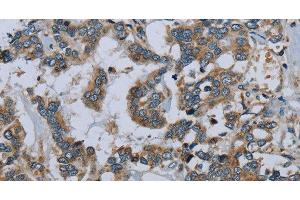 Immunohistochemistry of paraffin-embedded Human liver cancer using PCK2 Polyclonal Antibody at dilution of 1:60 (PEPCK Antikörper)