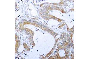 Immunohistochemical analysis of BCLX (pT47) staining in human colon cancer formalin fixed paraffin embedded tissue section. (BCL2L1 Antikörper  (pSer47))
