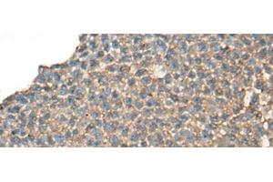 Immunohistochemistry of paraffin-embedded Human ovarian cancer tissue using CABP5 Polyclonal Antibody at dilution of 1:65(x200) (CABP5 Antikörper)