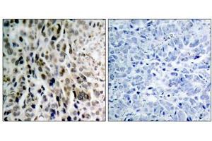 Immunohistochemical analysis of paraffin- embedded human lung carcinoma tissue using Chk2 (phospho-Thr68) antibody (E011061). (CHEK2 Antikörper  (pThr68))