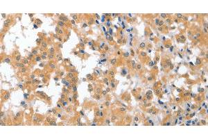 Immunohistochemistry of paraffin-embedded Human thyroid cancer tissue using CDR2 Polyclonal Antibody at dilution 1:60 (CDR2 Antikörper)