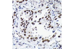 Immunohistochemistry of paraffin-embedded human lung cancer using HDGF Rabbit pAb  at dilution of 1:50 (40x lens). (HDGF Antikörper  (AA 1-240))