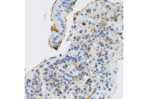 Immunohistochemistry of paraffin-embedded human gastric cancer using CD117/c-Kit antibody (ABIN6133454, ABIN6142896, ABIN6142898 and ABIN6213818) at dilution of 1:150 (40x lens). (KIT Antikörper  (AA 25-295))
