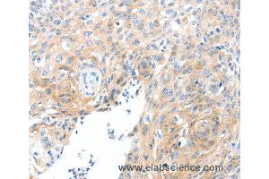 Immunohistochemistry of Human cervical cancer using SLC22A17 Polyclonal Antibody at dilution of 1:30