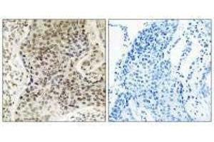 Immunohistochemistry analysis of paraffin-embedded human lung carcinoma tissue, using TSEN54 antibody. (TSEN54 Antikörper)