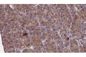 ABIN6273980 at 1/100 staining Human liver cancer tissue by IHC-P. (OR2M4 Antikörper)