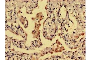 Immunohistochemistry analysis of human lung cancer using ABIN7149466 at dilution of 1:100 (Dopamine Receptor d1 Antikörper  (AA 338-446))