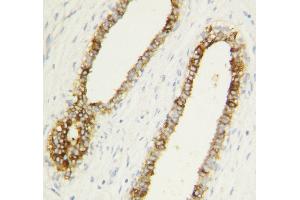 Anti-Caspase-1(P10) antibody, IHC(P) IHC(P): Human Mammary Cancer Tissue