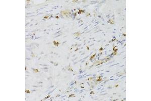 Immunohistochemistry of paraffin-embedded human adenomyosis using LSP1 Antibody (ABIN6130532, ABIN6143368, ABIN6143370 and ABIN6221252) at dilution of 1:100 (40x lens). (LSP1 Antikörper  (AA 1-339))