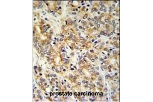 TXNDC12 Antibody (C-term) (ABIN651065 and ABIN2840056) IHC analysis in formalin fixed and paraffin embedded prostate carcinoma followed by peroxidase conjugation of the secondary antibody and DAB staining. (TXNDC12 Antikörper  (C-Term))
