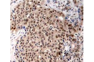 Immunohistochemistry of paraffin-embedded Human breast carcinoma using Phospho-MAPKAPK2(T334) Polyclonal Antibody (MAPKAP Kinase 2 Antikörper  (pThr334))