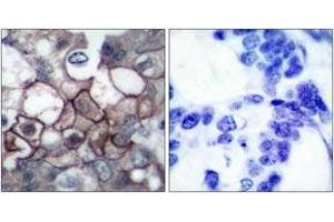 Immunohistochemistry analysis of paraffin-embedded human breast carcinoma, using EGFR (Phospho-Tyr1197) Antibody. (EGFR Antikörper  (pTyr1197))