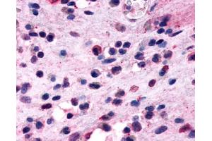 Anti-GPR44 / CRTH2 antibody IHC of human nasal mucosa, eosinophils. (Prostaglandin D2 Receptor 2 (PTGDR2) (Extracellular Domain) Antikörper)
