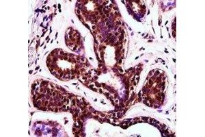 PDCD4 antibody immunohistochemistry analysis in formalin fixed and paraffin embedded human breast tissue. (PDCD4 Antikörper  (AA 121-149))