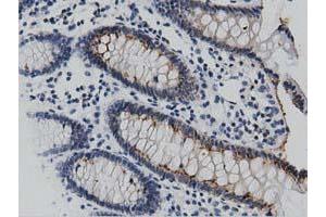 Immunohistochemical staining of paraffin-embedded Human lymphoma tissue using anti-DNAJA2 mouse monoclonal antibody. (DNAJA2 Antikörper)