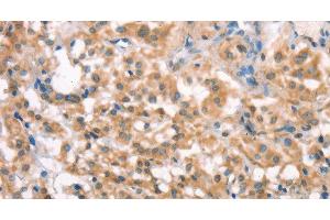 Immunohistochemistry of paraffin-embedded Human thyroid cancer tissue using LATS2 Polyclonal Antibody at dilution 1:30 (LATS2 Antikörper)