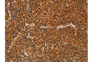 The image on the left is immunohistochemistry of paraffin-embedded Human liver cancer tissue using ABIN7129834(IKZF3 Antibody) at dilution 1/60, on the right is treated with fusion protein. (IKZF3 Antikörper)