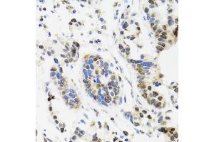 Immunohistochemistry of paraffin-embedded human gastric cancer using TOP1 antibody. (Topoisomerase I Antikörper)