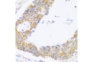 Immunohistochemistry of paraffin-embedded human colon carcinoma using ZAK antibody (ABIN5975284) at dilution of 1/100 (40x lens). (ZAK Antikörper)