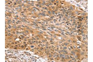 The image on the left is immunohistochemistry of paraffin-embedded Human esophagus cancer tissue using ABIN7131123(SNX11 Antibody) at dilution 1/30, on the right is treated with fusion protein. (SNX11 Antikörper)