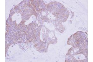 IHC-P Image Immunohistochemical analysis of paraffin-embedded human colon carcinoma, using PTER, antibody at 1:500 dilution. (PTER Antikörper)